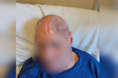 The cyclist sustained serious head injury after collision.